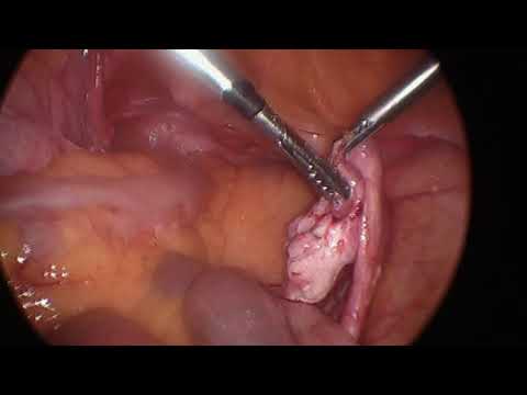 Ooforoplastia direita e liberação de aderências por vídeo/ Oophoroplasty  and video adhesion release 